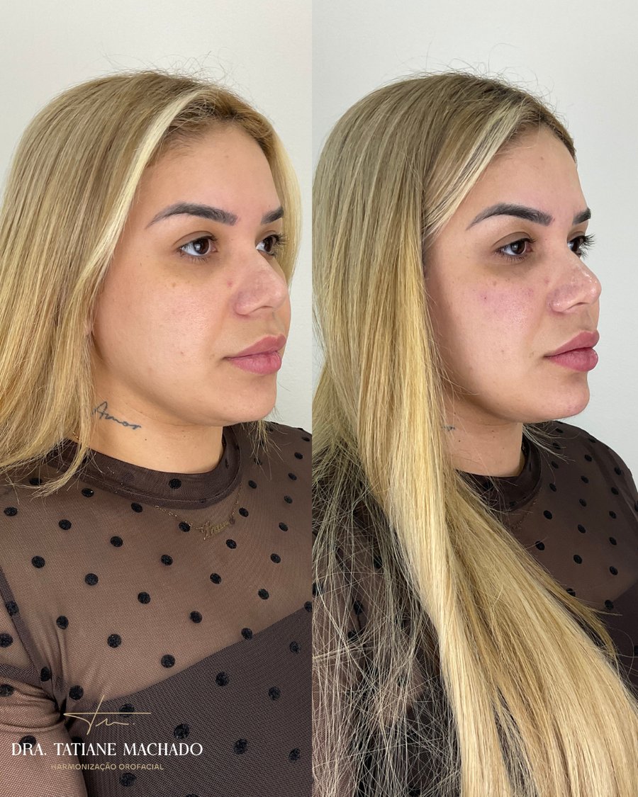 Antes e depois - Harmonização facial